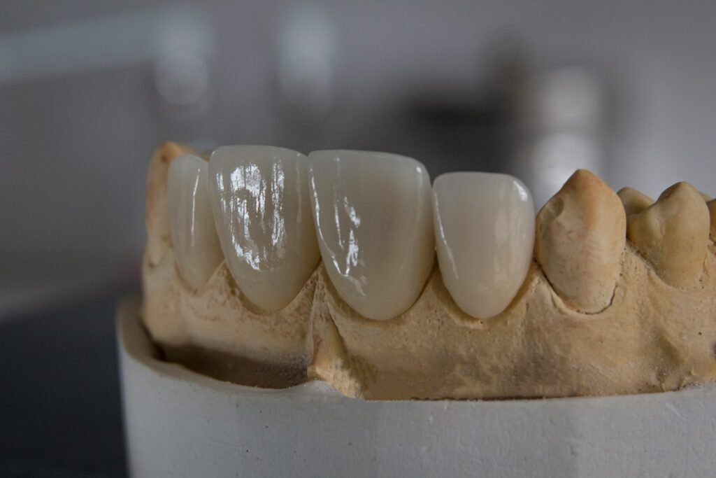dental bridge